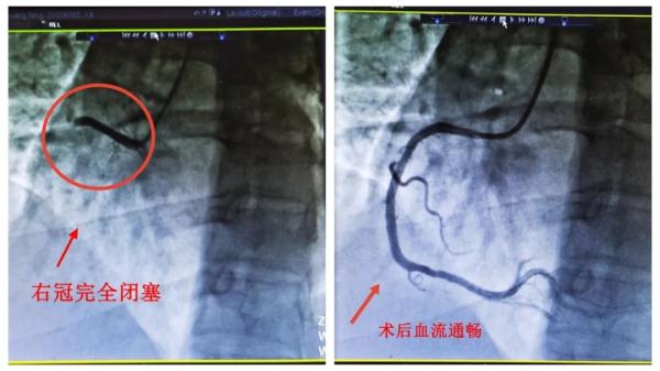 阳性一个月后肺栓塞风险增加33倍